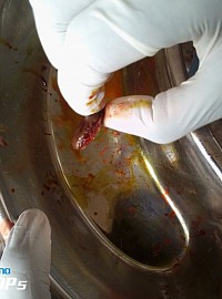 Medical procedures