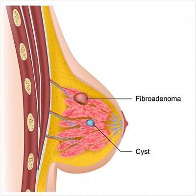 Breast cancer