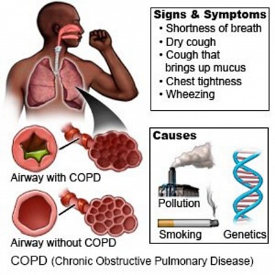 COPD