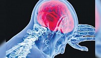 Meningitis